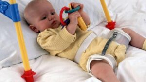 Kalça Çıkığı Tedavisi