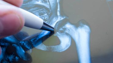 Kalça Çıkığı Çeşitleri