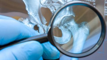 Kalça Displazisi Nedenleri