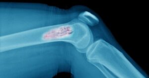 Kemik Tümörü Belirtileri 