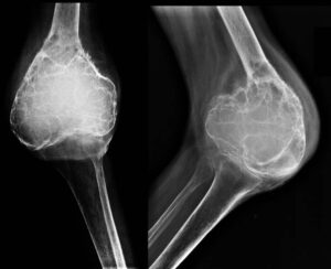 Kemik Tümörü Belirtileri