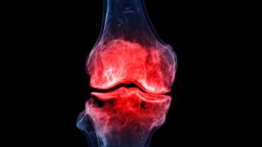 Ön Çapraz Bağ Kopması