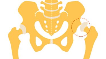 Gelişimsel Kalça Displazisi Tedavisi