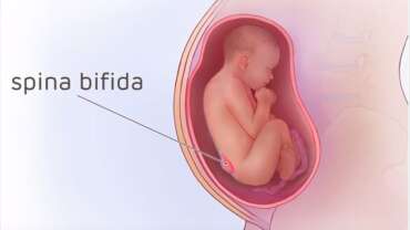 Spina Bifida Hastalığı Nedir?