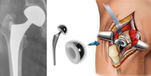 Total Kalça Protezi Ameliyatı