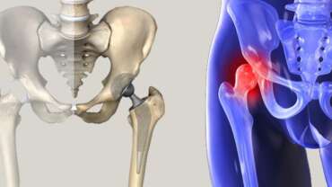 Kalça Çıkığı Ameliyatı