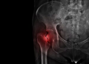 Kalça Kırığı Nedir?