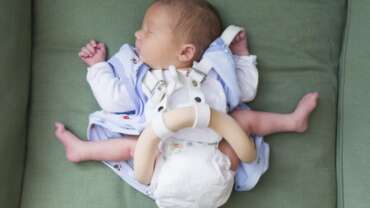 Çocuklarda Kalça Çıkığı