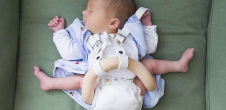 Çocuklarda Kalça Çıkığı