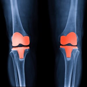 Yaşlılarda Diz Protezi Ameliyatı 