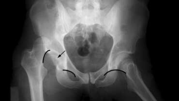 Gençlerde Kalça Çıkığı