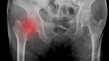 Gençlerde Kalça Kırığı