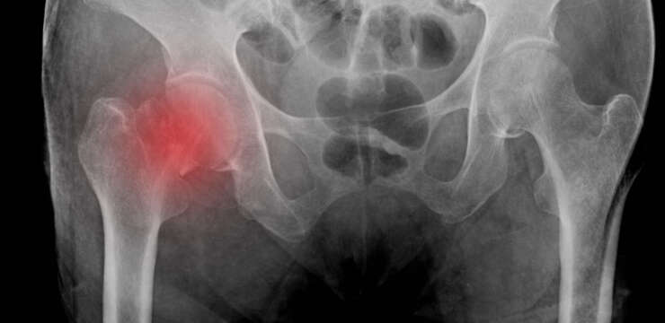 Gençlerde Kalça Kırığı