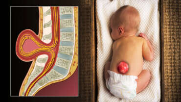 Spina Bifida Tipleri