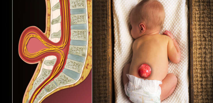 Spina Bifida Tipleri