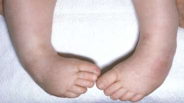 Çocuklarda Çarpık Ayak Hastalığı