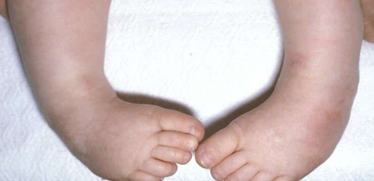 Çocuklarda Çarpık Ayak Hastalığı