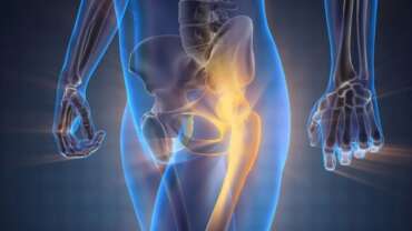 Kalça Çıkıklığı Belirtileri