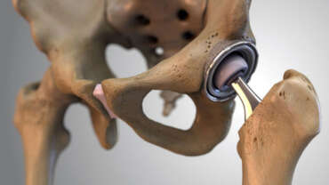 Kalça Protezi Ameliyatı Sonrası