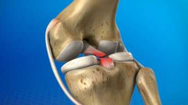 Ön Çapraz Bağ Yırtılması Belirtileri