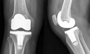 Diz Protezi Ameliyatı Fiyatları