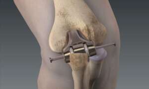 Diz Protezi Ameliyatı Fiyatları
